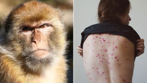 viruela del mono sintomas vacuna argentina caso sospechoso