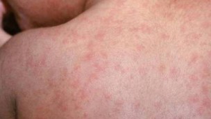 Sociedad, Sarampión, contagio, Ministerio de Salud, enfermedad,