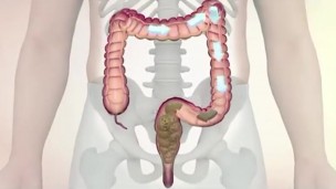 Cáncer de colon: hay 15 mil nuevos casos por año en Argentina