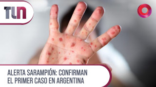 Alerta sarampión: Confirman el primer caso en Argentina 