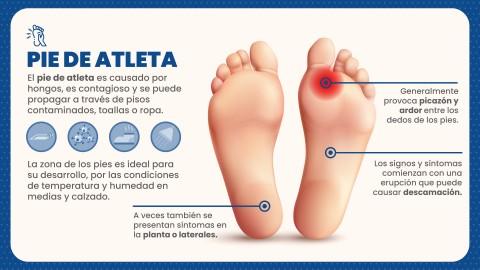 Hongos en los pies: prevención y tratamiento